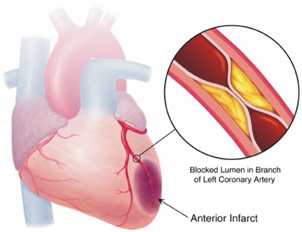 Unha das complicacións da presión arterial alta é a enfermidade cardíaca da enfermidade coronaria
